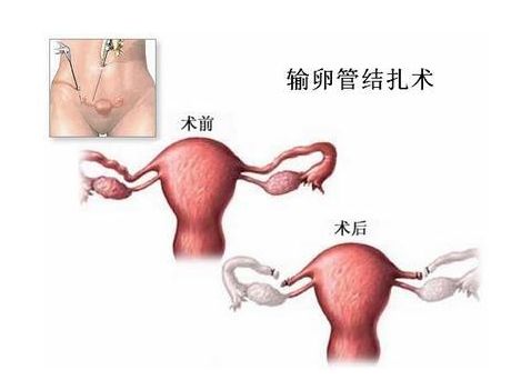 捐卵